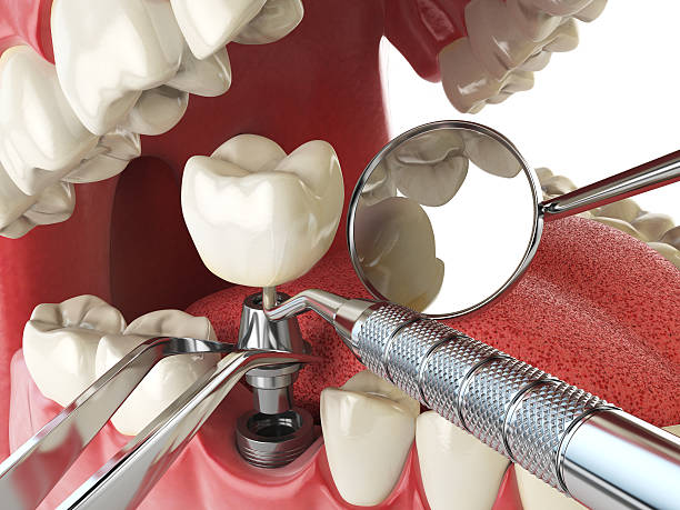 Best Emergency Root Canal Treatment in New Smyrna Beach, FL
